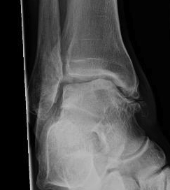 Ankle OA Post Lateral Ligament Instability